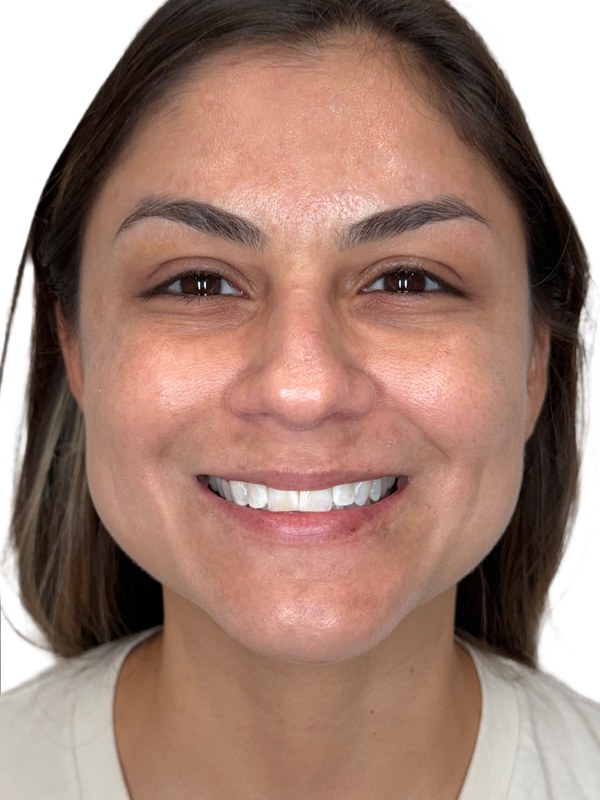 Botox after, the same patient showing a softer, more rested expression following a multi-area Botox treatment by Natasha Wilkes, NP.