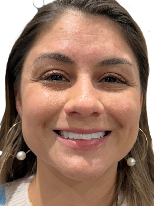 Botox before, visible expression lines across the face prior to a comprehensive neuromodulator treatment at The Aesthetic Ranch in Fort Lauderdale, FL.