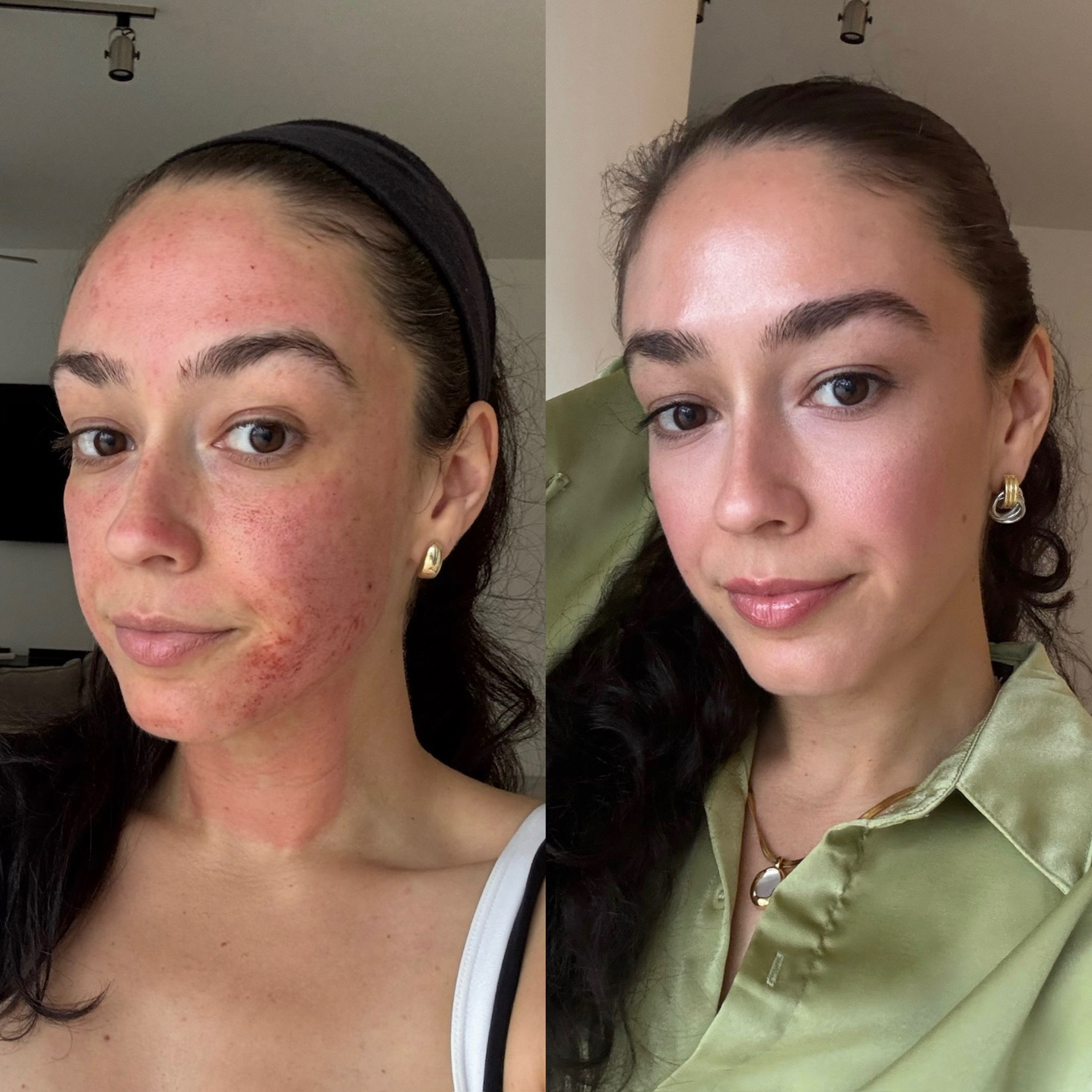 Microneedling progression at The Aesthetic Ranch in Fort Lauderdale, FL, side-by-side composite showing the same patient immediately after a SkinPen Precision microneedling session and again at day nine, with visibly smoother texture, refined pores, and improved skin clarity following the collagen healing response activated by Natasha Wilkes, NP.