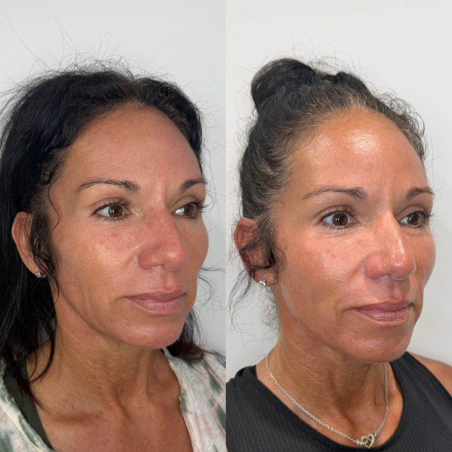 Sculptra before and after at The Aesthetic Ranch in Fort Lauderdale, FL, three-quarter view of a female patient showing improved mid-face volume, lifted cheek contour, and refined overall skin quality after a Sculptra Aesthetic collagen-stimulating treatment series by Natasha Wilkes, NP.